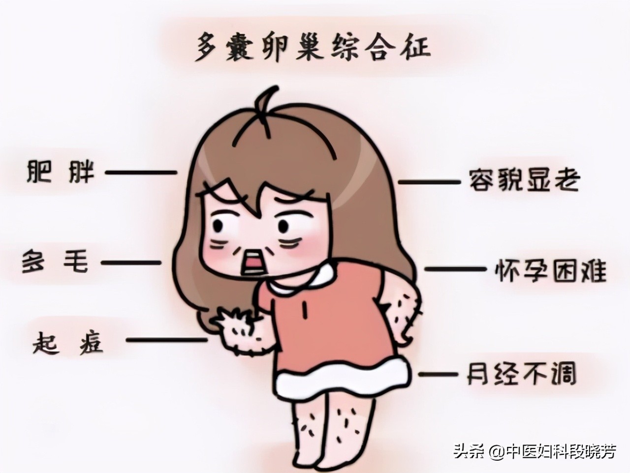 多囊卵巢综合征诊断思路,中医段晓芳看多囊效果怎么样