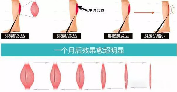瘦腿针和抽脂哪个瘦小腿明显点,有效瘦腿方法小腿