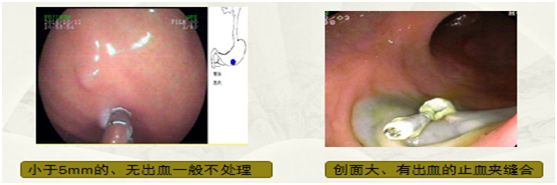 内镜下摘除息肉后几天能走路,内镜摘除肠胃息肉后饮食