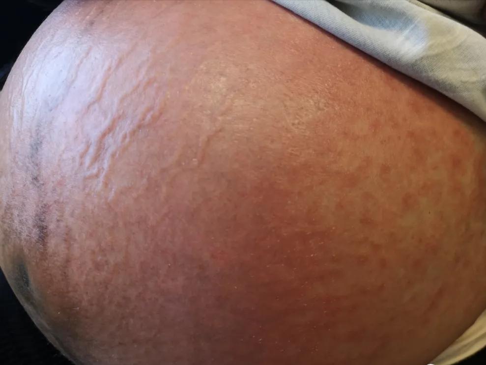 怀孕期间肚皮痒有红斑是怎么回事,孕晚期妊娠瘙痒性丘疹怎么治疗