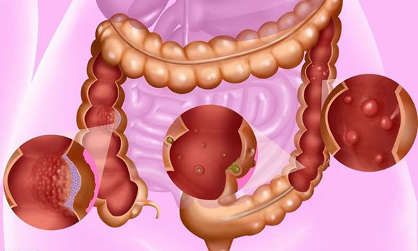 70岁老人可以做痔疮手术吗,家里老人治痔疮的方法