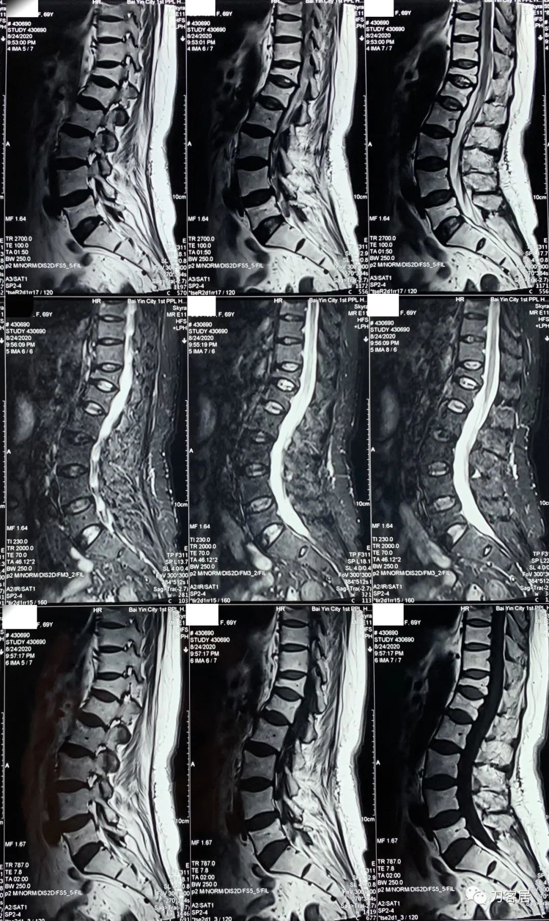 脊柱骨质疏松性压缩性骨折,老年骨质疏松压缩性骨折诊治