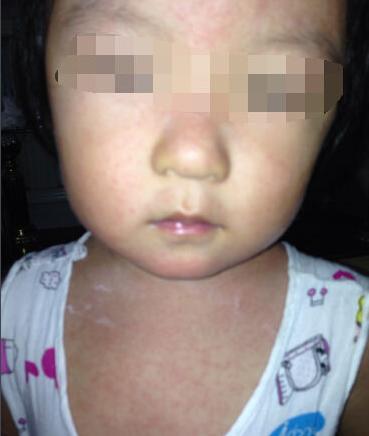 宝宝热出痱子婆婆说烂胎盘,高温天气宝宝热痱子怎么治好得快