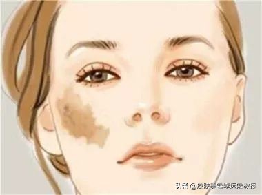 做一个脸上无斑的女人,女人脸上没有斑了