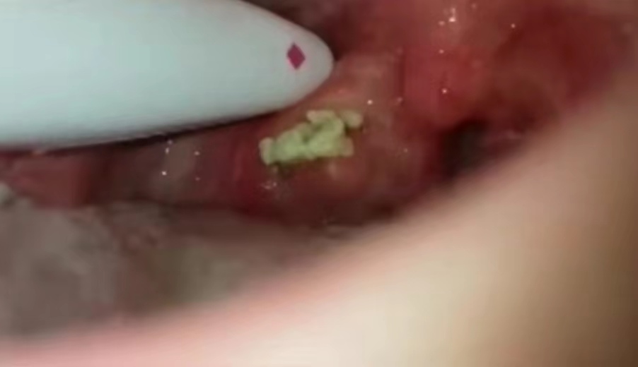 口臭知识,口臭中药配方大全