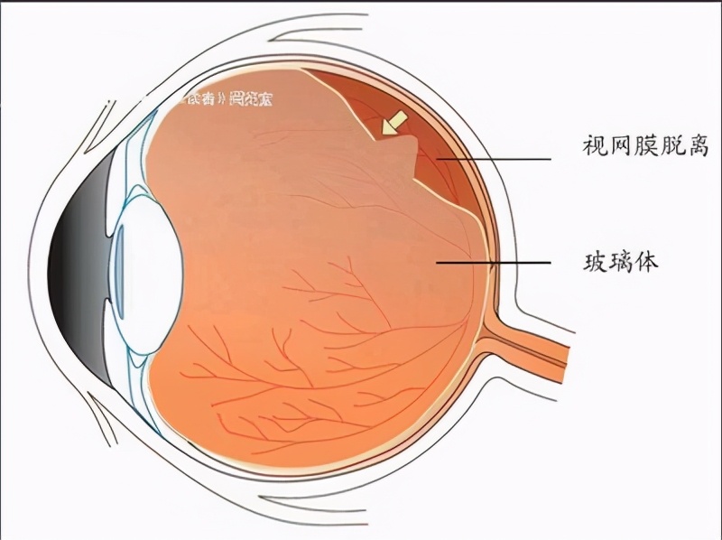 视网膜色素变性夜盲后几年失明,视网膜色素变性一定有夜盲症吗