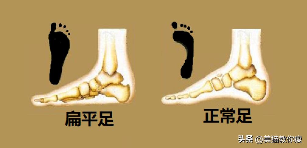 小学生肌肉腿怎么瘦成筷子腿,三天肌肉腿瘦成筷子腿