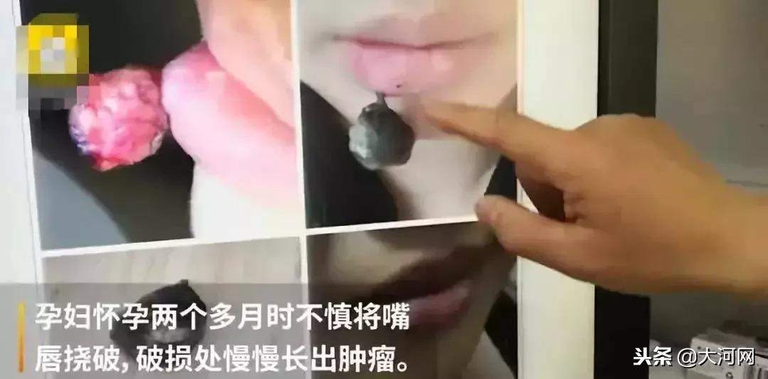 孕妇不慎挠破嘴唇竟长出血管瘤,孕妇嘴血管瘤