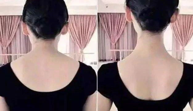 斜方肌肥大的主要原因是什么,斜方肌肥大是不是锁骨就不明显