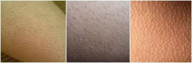 解决鸡皮肤的最有效方法,鸡皮肤用产品后起皮怎么改善