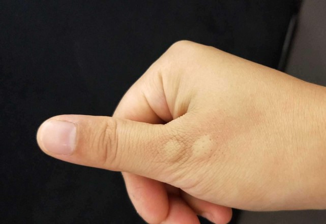 红霉素软膏多少钱有什么作用,几块钱的红霉素软膏淡斑