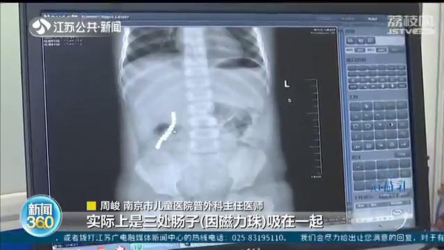孩子误吞磁力珠医院视频,小孩误吞一颗磁力珠怎么办