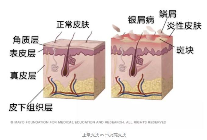 印度最新银屑病仿制药,日本进口银屑病新药