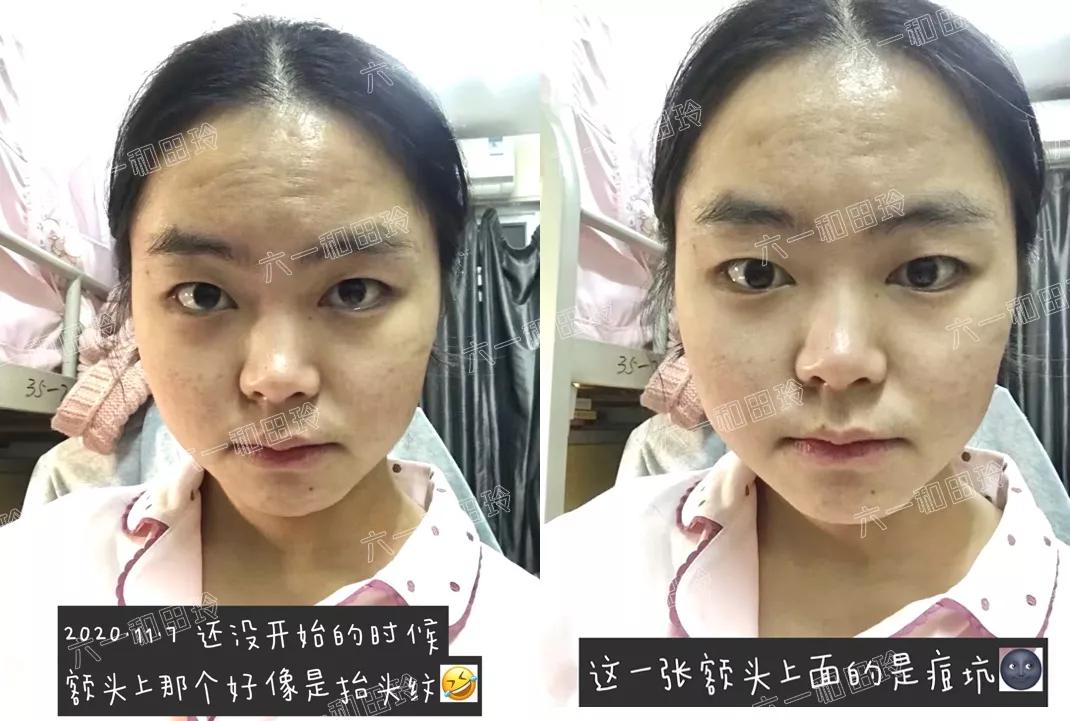 3250个文字很长，希望有痘坑的你看下去