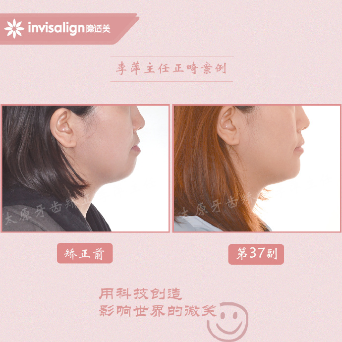 改善一侧咬肌,如何改善面型