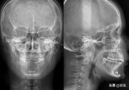 18岁土肥圆豪掷800万全身整形，鼻子6次大整假体穿出，效果却超美