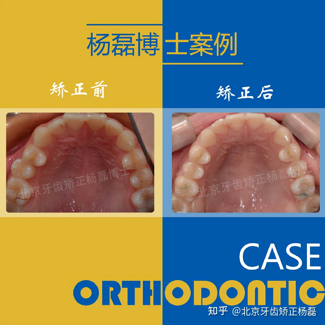 整牙半隐形牙套,缺牙可以用隐形牙套矫正的全过程