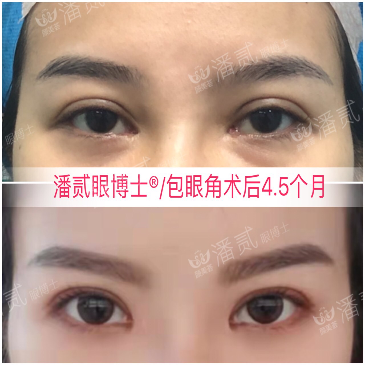 开内眼角会留疤的照片,开内眼角的疤痕变白色了怎么办