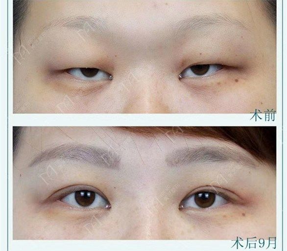 为什么有人割了双眼皮反而不好看,为啥有些人割了双眼皮变化巨大