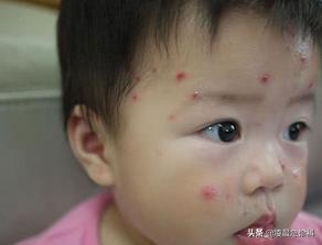 宝宝长水痘怎么处理好得快,小孩子水痘要是没发好会怎么样