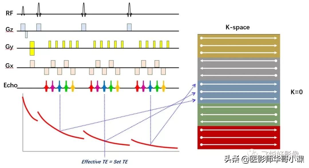 「飞利浦磁共振技术」胆道系统胆胰管水成像之3D_MRCP_BH