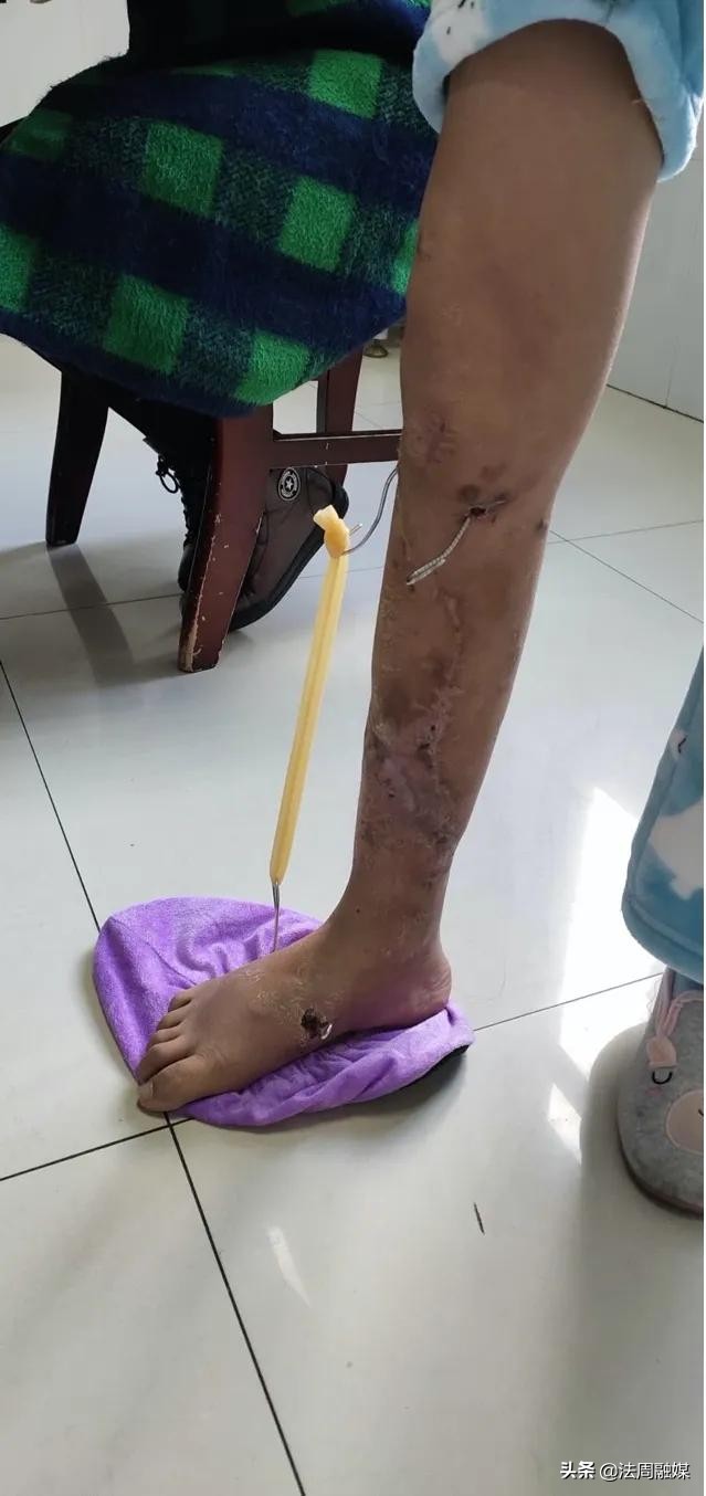 交通事故小腿胫骨骨折做手术,常德市第一中医医院骨伤科