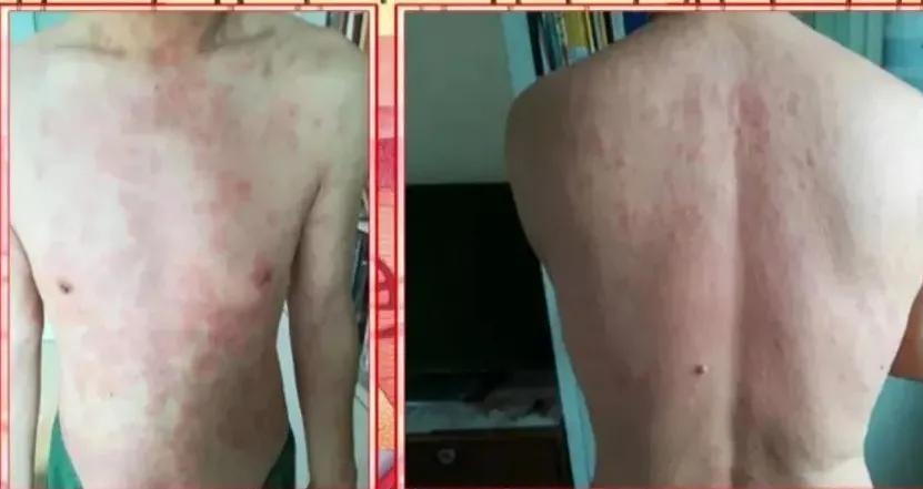 皮肤病反反复复怎么办才好,皮肤病很痒怎么办