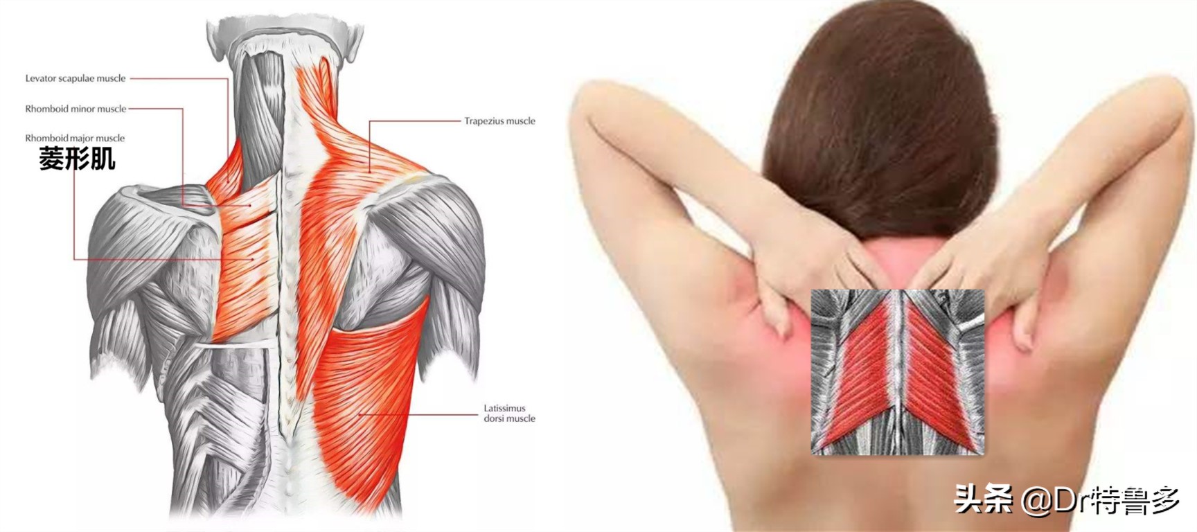 蝴蝶骨不是一种病吗,蝴蝶骨是颈椎病吗