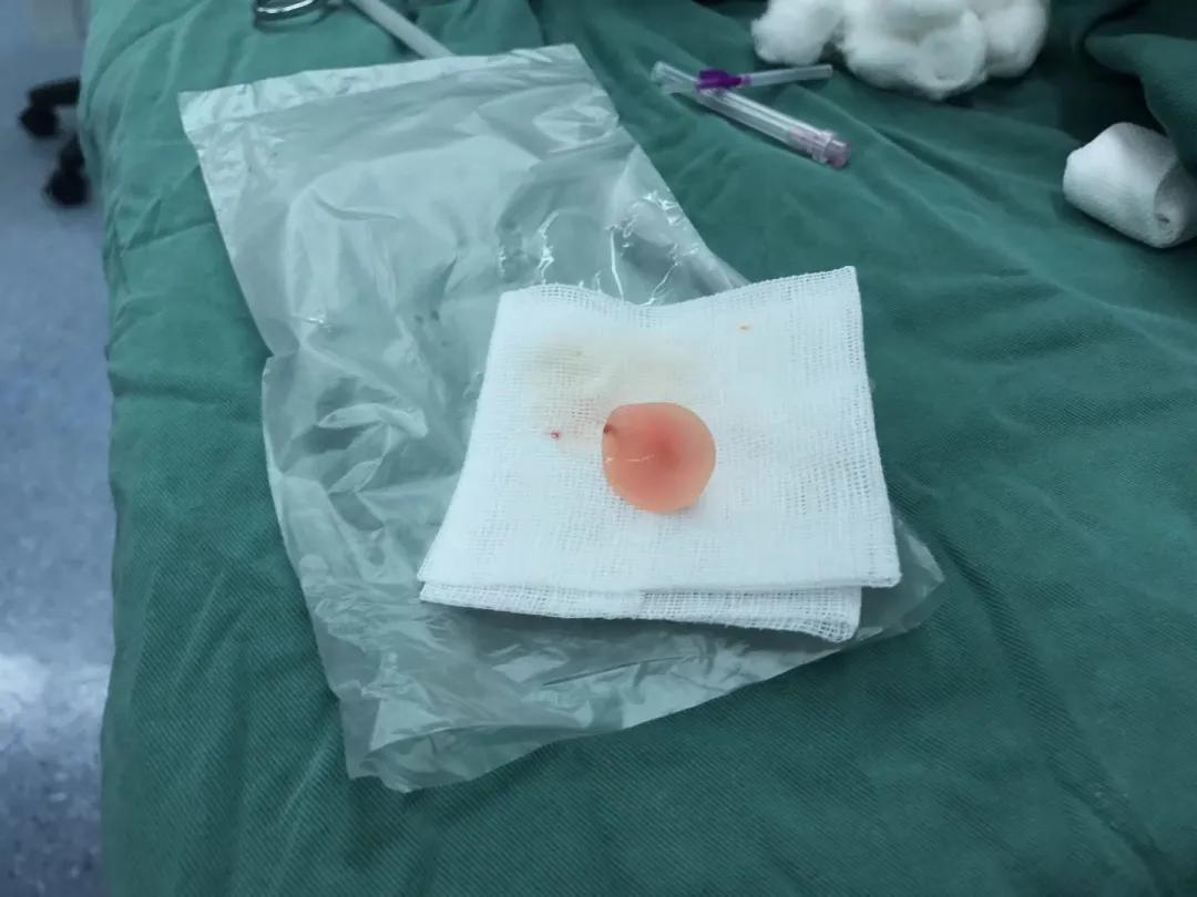 四岁小男孩往小丁丁里塞弹珠？那些年孩子塞进去的东西远不止这个