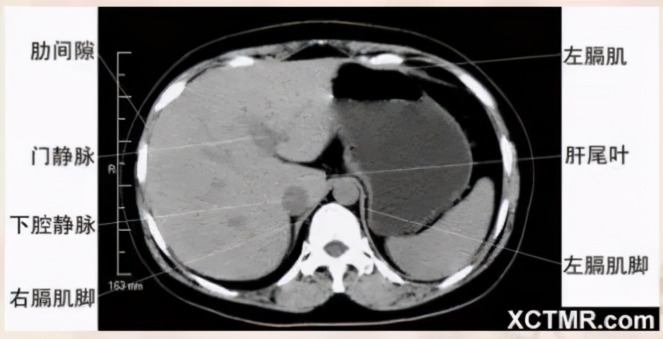 女性盆腔ct断层解剖结构图,女性盆腔脏器ct解剖