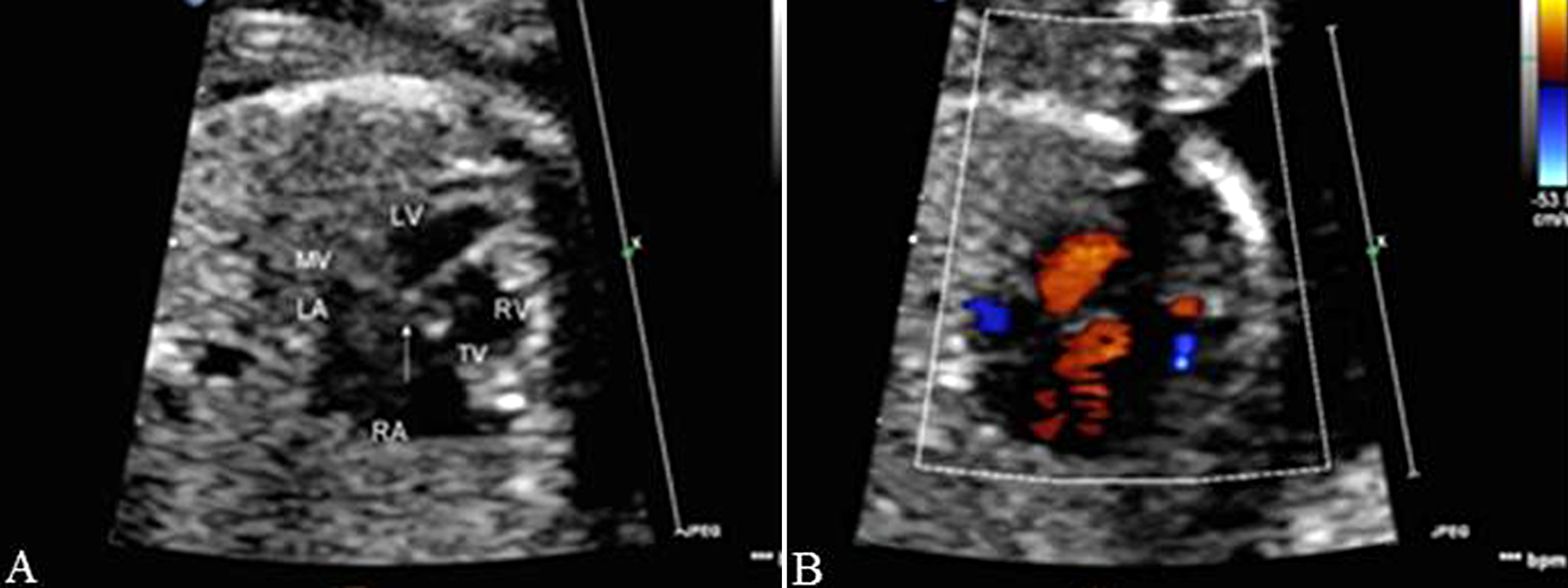 胎儿心脏发育异常微小室间隔缺损,胎儿心脏缺损1.3毫米严重吗