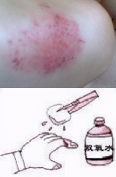 青少年常见运动伤害的处理方式,儿童常见运动损伤的正确处理