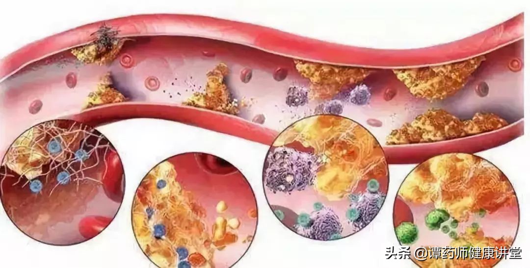 最新降胆固醇新药,海南降血脂针剂