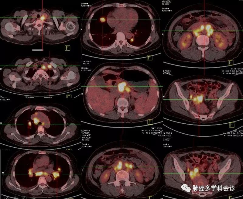 肺癌淋巴结转移和淋巴癌区别,肺和气管之间有恶性淋巴转移