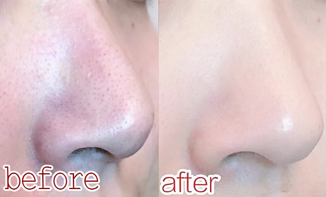 屈臣氏有种“贵妇级”的水,全是维生素,5次不到黑头闭口全没了