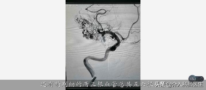 50岁大姐出车祸,50岁大姐脑出血康复成功案例