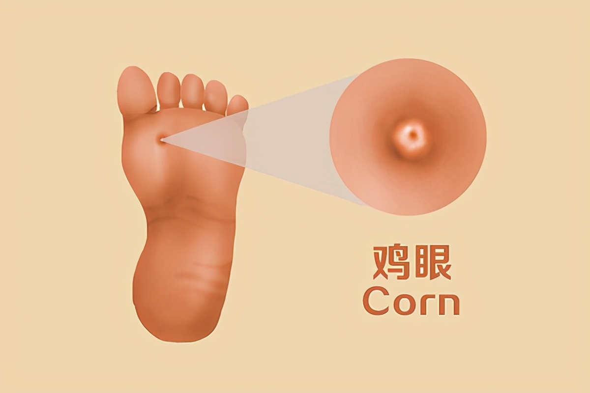 脚上长鸡眼什么方法去掉最方便,脚上长鸡眼怎么去除鸡眼