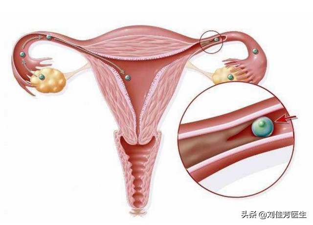 输卵管堵塞最有效的疏通方法,输卵管堵塞疏通妙招