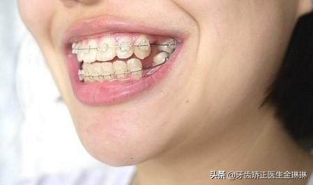 淄川口碑最好的矫正牙齿医院,淄博市口腔医院哪个专家整牙好