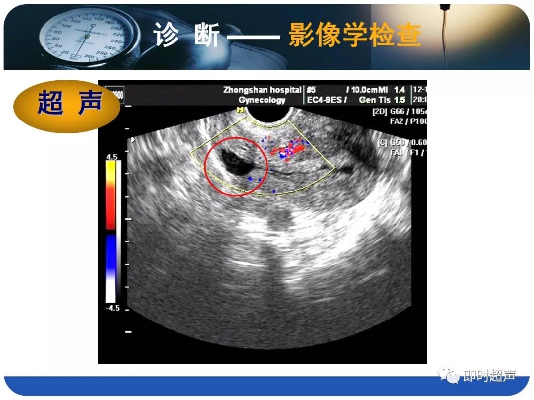 孕妇剖宫产瘢痕憩室,剖宫产瘢痕憩室息肉