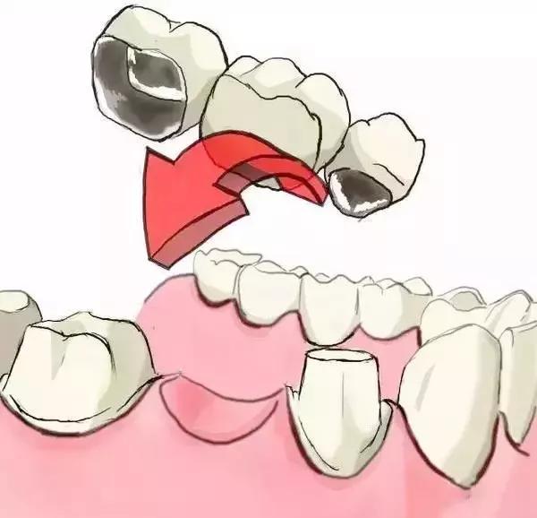 为什么做了烤瓷牙的人都后悔,烤瓷牙套弄上后悔了该怎么办