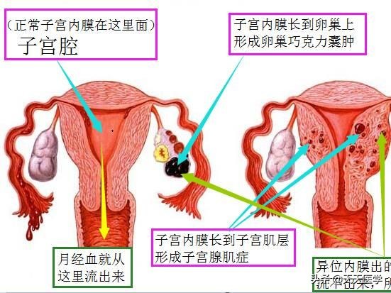 子宫内膜异位症会引起ca125偏高吗,子宫内膜异位症的用药