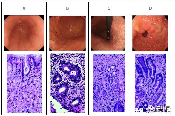 慢性浅表性胃炎伴糜烂还肠化生,肠化生伴轻度异型增生能治愈吗