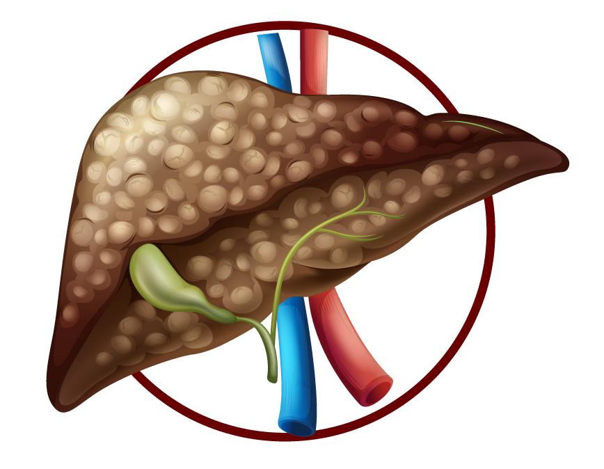 肝癌患者吃什么食物能提高免疫力,糖尿病人得肝癌晚期吃什么食物好
