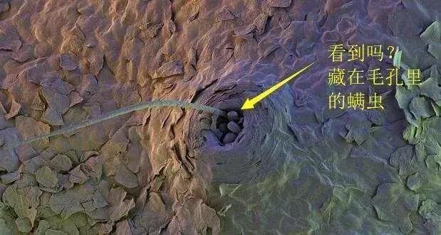 人人都会长黑头吗,好多人都长黑头吗