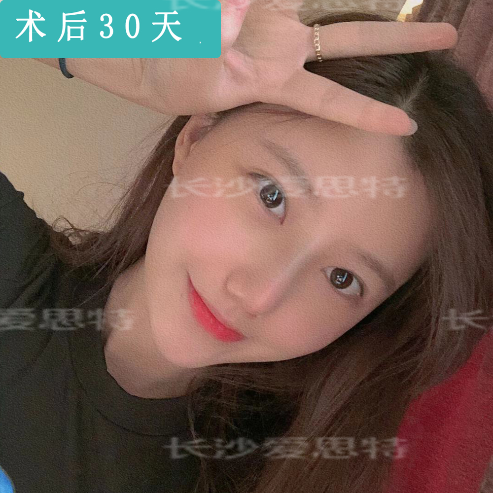 耳软骨隆鼻后吃什么恢复快,耳软骨隆鼻取出假体多久恢复原样