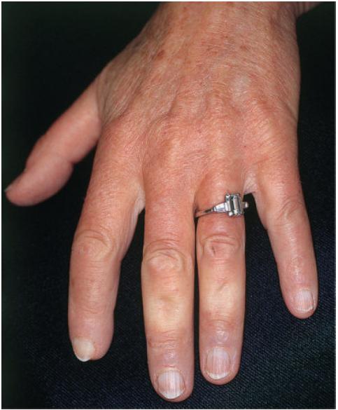 硬皮病是一种什么病,硬皮病由什么造成的