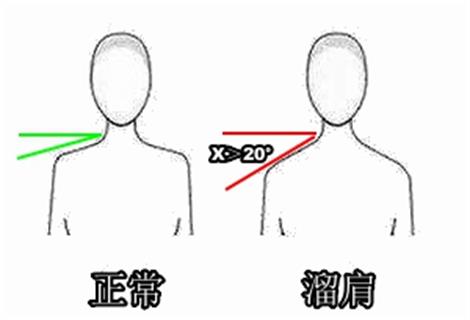 溜肩是斜方肌紧张嘛,如何改善肩胛骨和斜方肌
