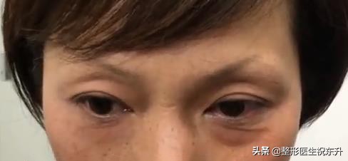 祛眼袋后眼袋出现皱纹怎么办,祛眼袋后凹陷怎么办