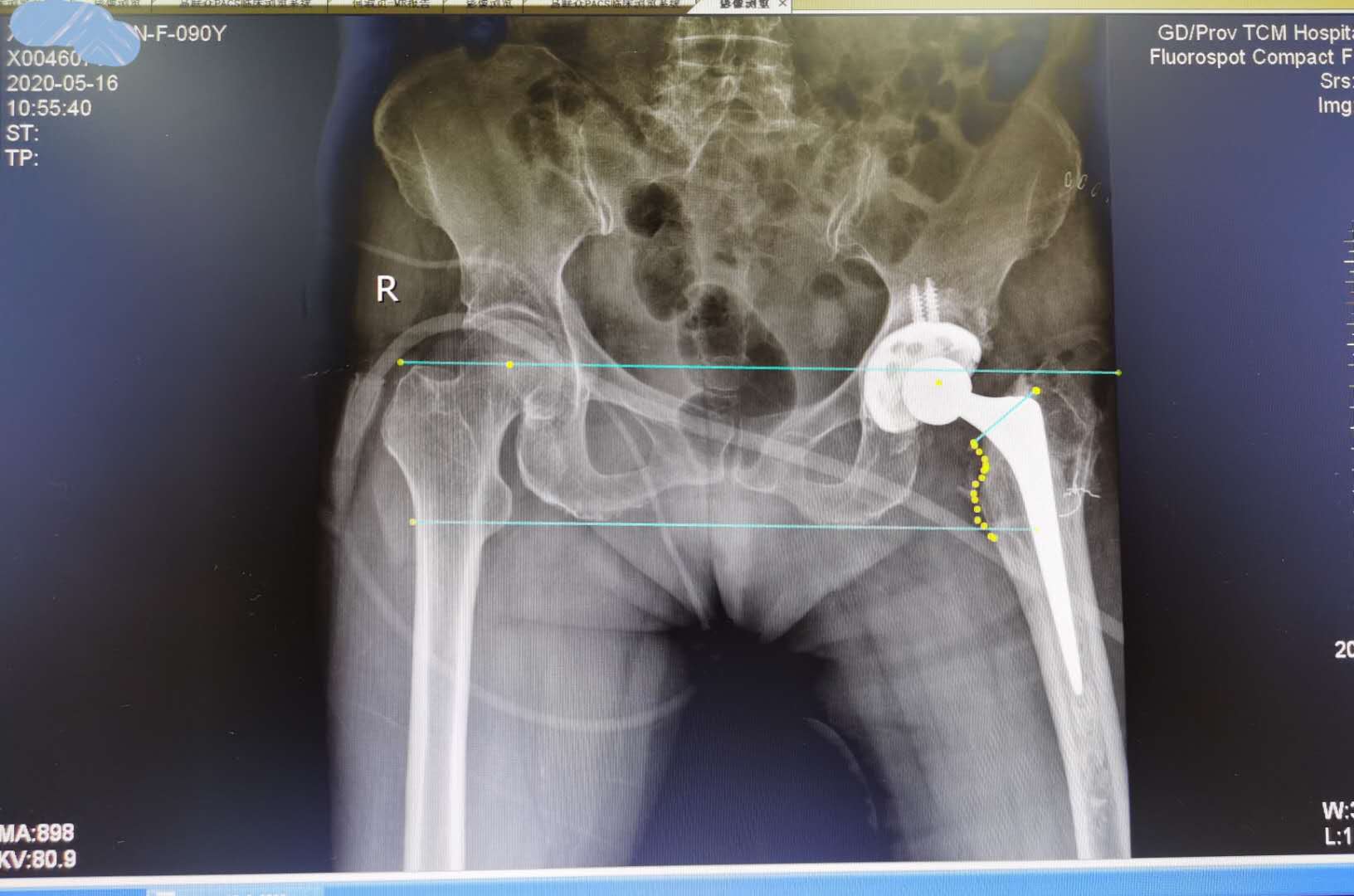 90岁老人髋关节置换术死亡率多高,90岁老人微创髋关节置换技术